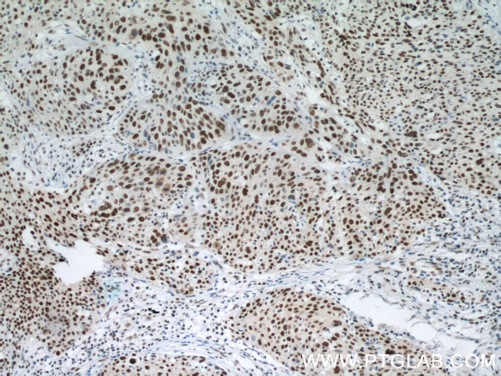 Immunohistochemistry (IHC) staining of human lung cancer tissue using SMARCA4/BRG1 Polyclonal antibody (21634-1-AP)