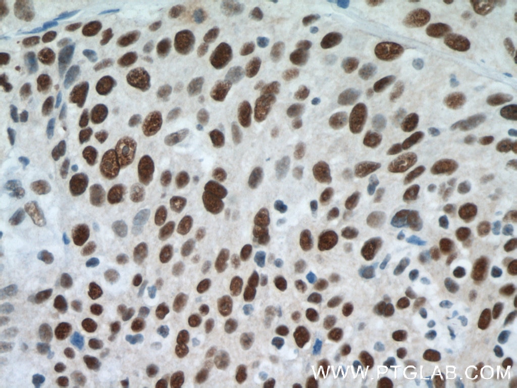 Immunohistochemistry (IHC) staining of human lung cancer tissue using SMARCA4/BRG1 Polyclonal antibody (21634-1-AP)