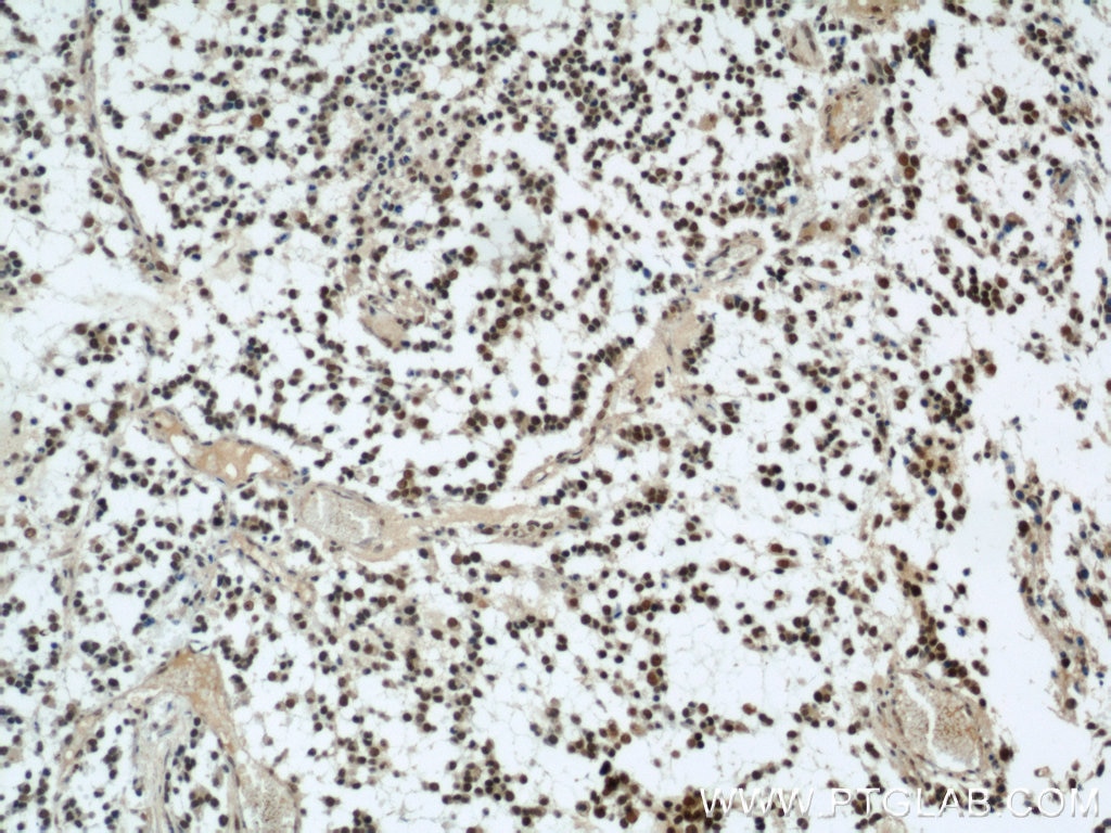 Immunohistochemistry (IHC) staining of human gliomas tissue using SMARCA4/BRG1 Polyclonal antibody (21634-1-AP)