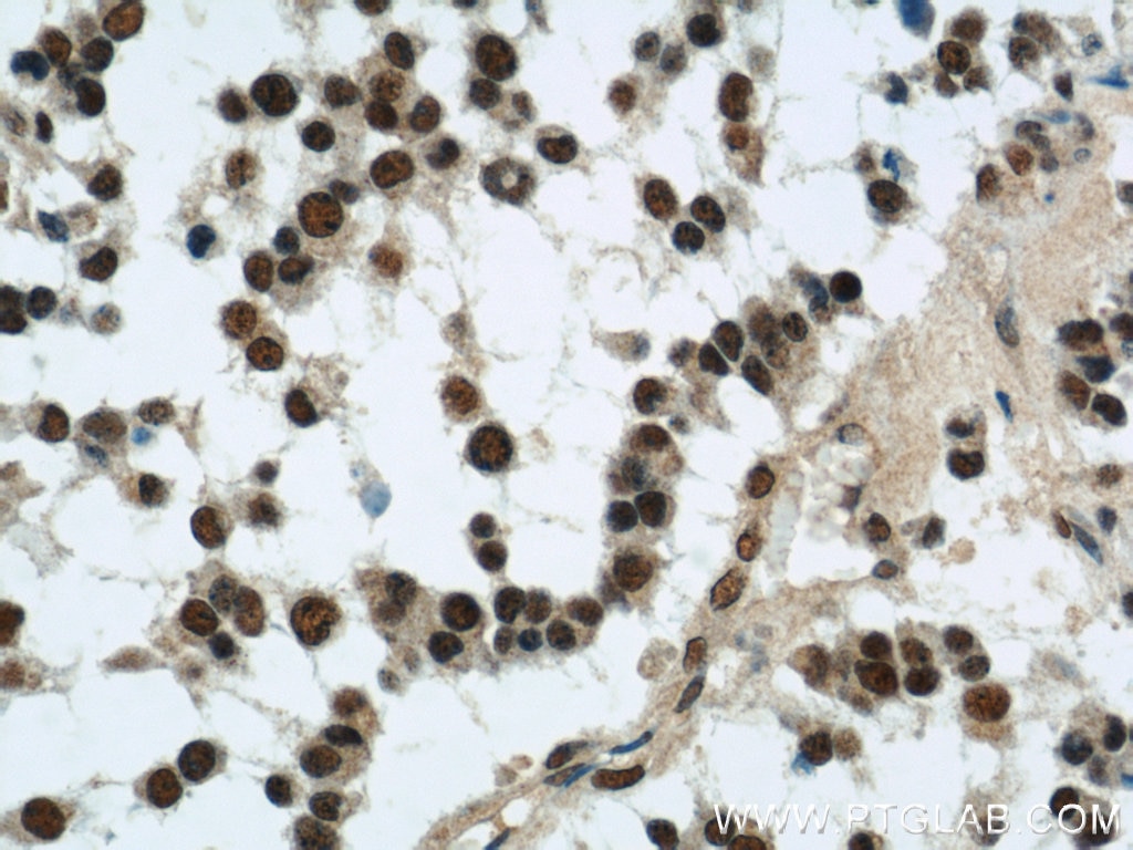 Immunohistochemistry (IHC) staining of human gliomas tissue using SMARCA4/BRG1 Polyclonal antibody (21634-1-AP)