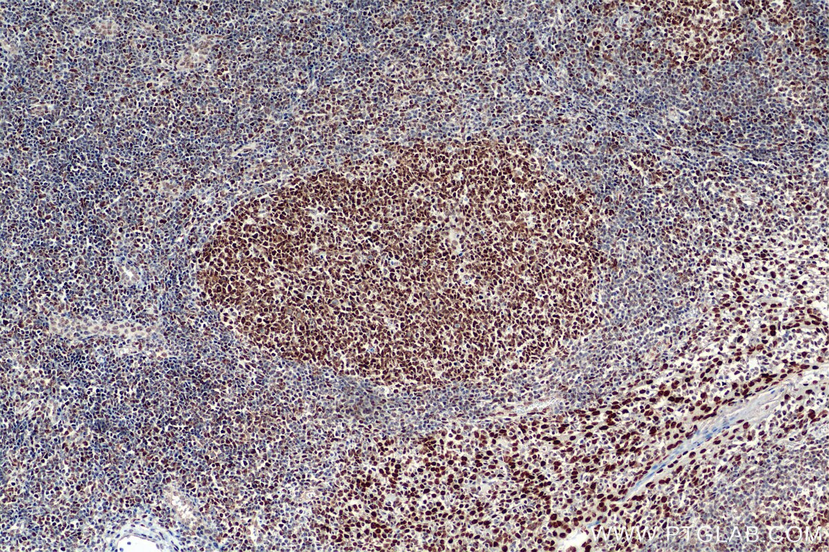 Immunohistochemistry (IHC) staining of human tonsillitis tissue using SMARCA4 Recombinant antibody (83310-2-RR)