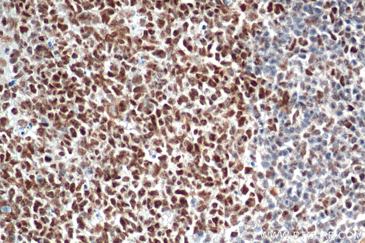 Immunohistochemistry (IHC) staining of human tonsillitis tissue using SMARCA4 Recombinant antibody (83310-2-RR)