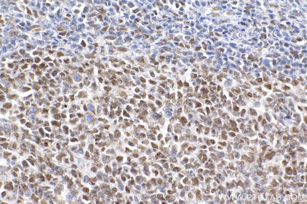 Immunohistochemistry (IHC) staining of human tonsillitis tissue using SMARCA4 Recombinant antibody (83310-7-RR)