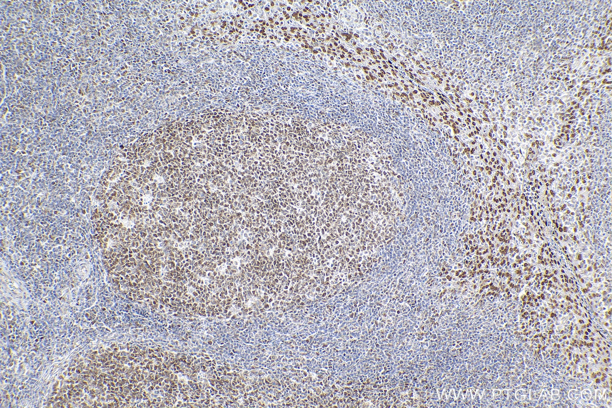 Immunohistochemistry (IHC) staining of human tonsillitis tissue using SMARCA4 Recombinant antibody (83310-7-RR)