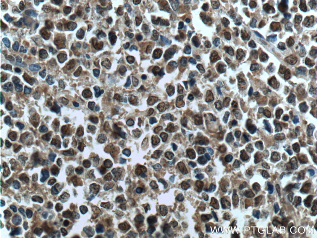 Immunohistochemistry (IHC) staining of human lymphoma tissue using SMARCB1 Polyclonal antibody (20654-1-AP)