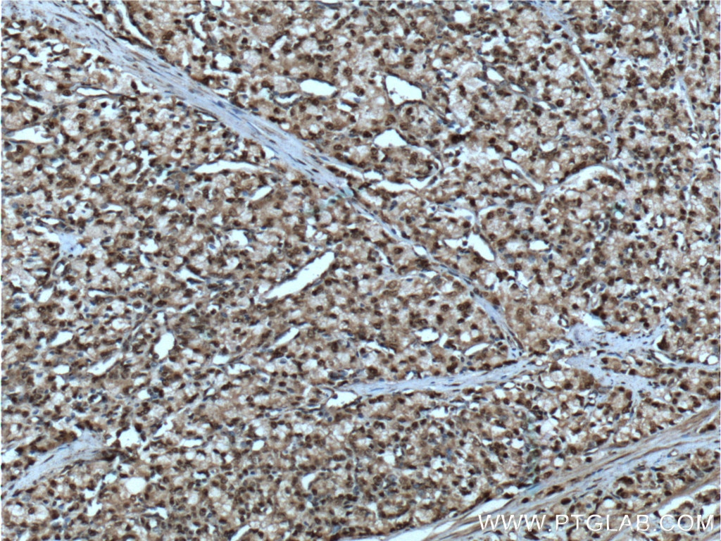 Immunohistochemistry (IHC) staining of human prostate cancer tissue using SMARCB1 Polyclonal antibody (20654-1-AP)