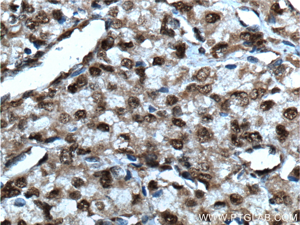 Immunohistochemistry (IHC) staining of human prostate cancer tissue using SMARCB1 Polyclonal antibody (20654-1-AP)