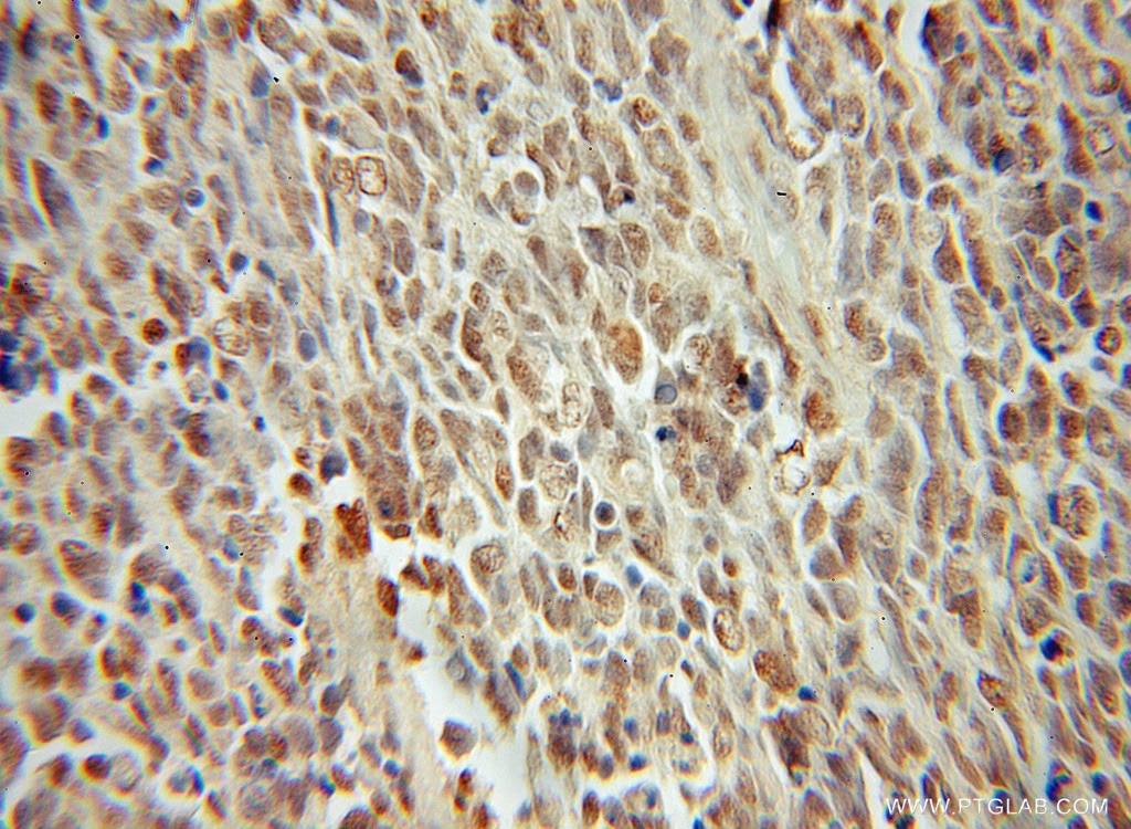 Immunohistochemistry (IHC) staining of human medulloblastoma tissue using BAF170 Polyclonal antibody (12018-1-AP)