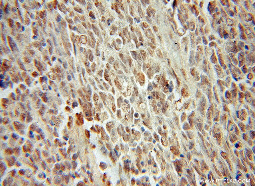 IHC staining of human medulloblastoma using 12018-1-AP