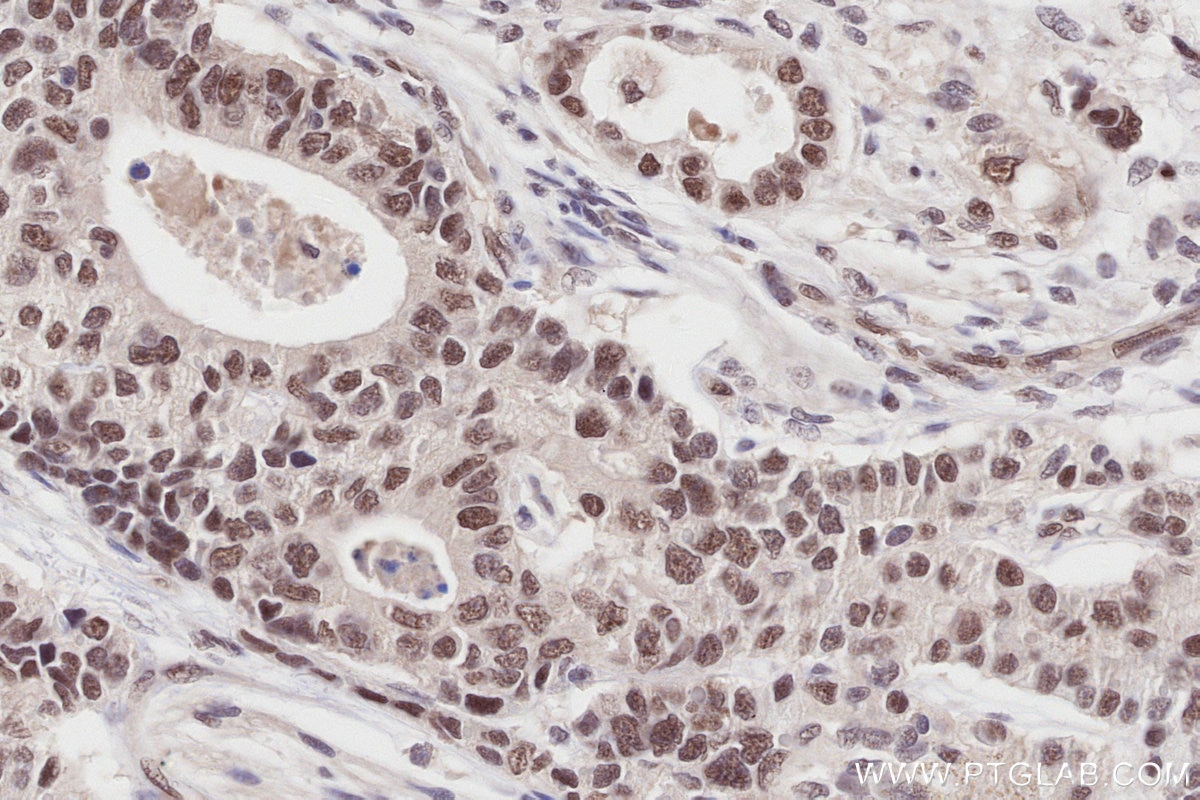 Immunohistochemistry (IHC) staining of human stomach cancer tissue using SMARCD1 Polyclonal antibody (10998-2-AP)