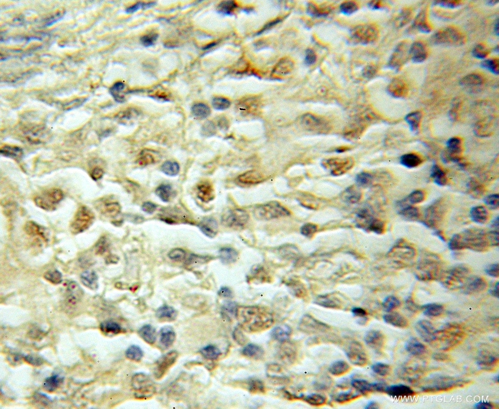 Immunohistochemistry (IHC) staining of human lymphoma tissue using SMARCD1 Polyclonal antibody (10998-2-AP)