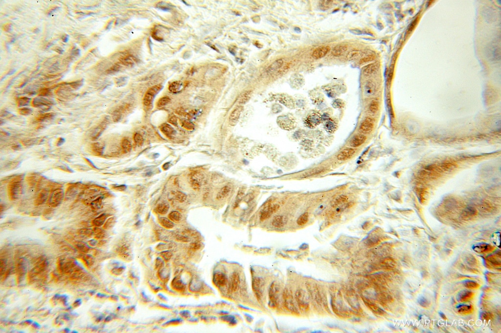 Immunohistochemistry (IHC) staining of human cervical cancer tissue using SMARCD2 Polyclonal antibody (11156-1-AP)