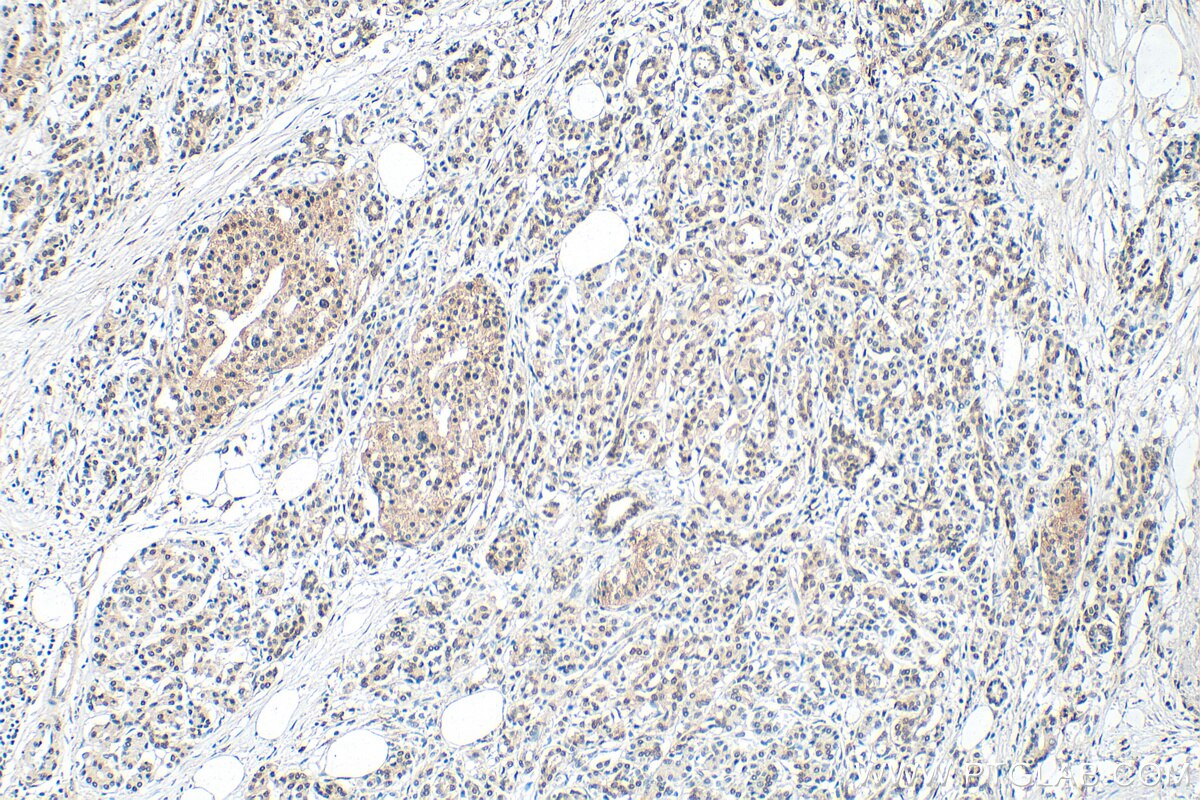 IHC staining of human pancreas cancer using 12838-1-AP