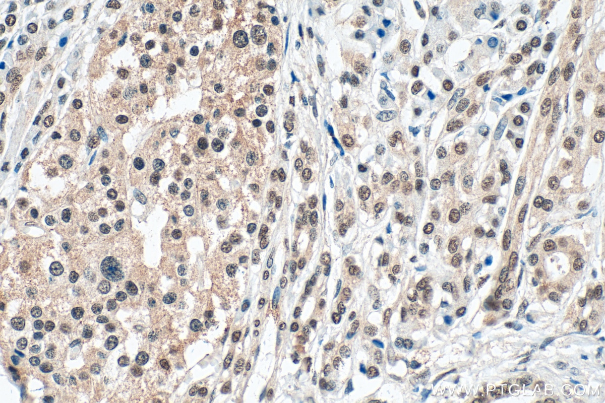 Immunohistochemistry (IHC) staining of human pancreas cancer tissue using SMARCD3 Polyclonal antibody (12838-1-AP)
