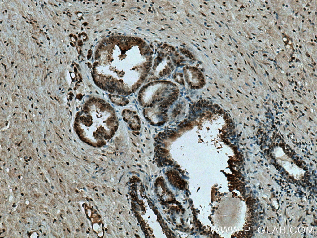 Immunohistochemistry (IHC) staining of human prostate cancer tissue using SMARCE1 Polyclonal antibody (10814-1-AP)