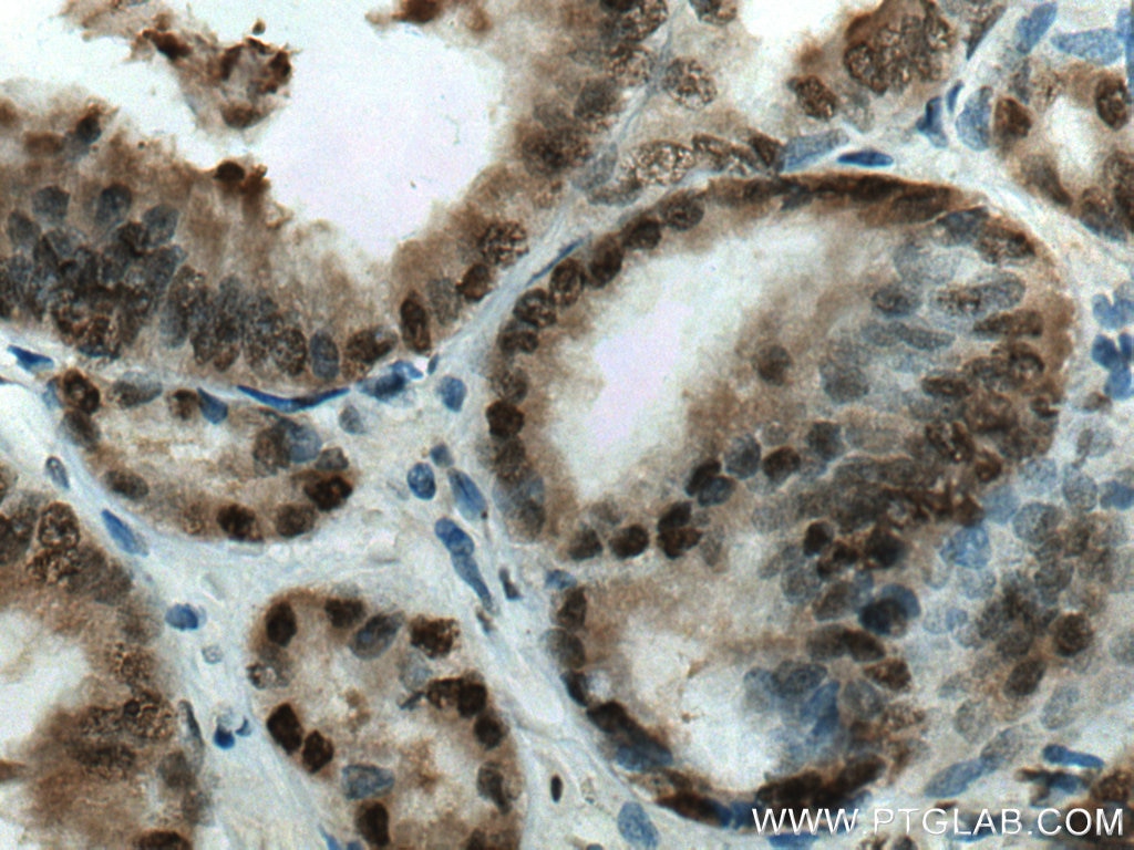 Immunohistochemistry (IHC) staining of human prostate cancer tissue using SMARCE1 Polyclonal antibody (10814-1-AP)