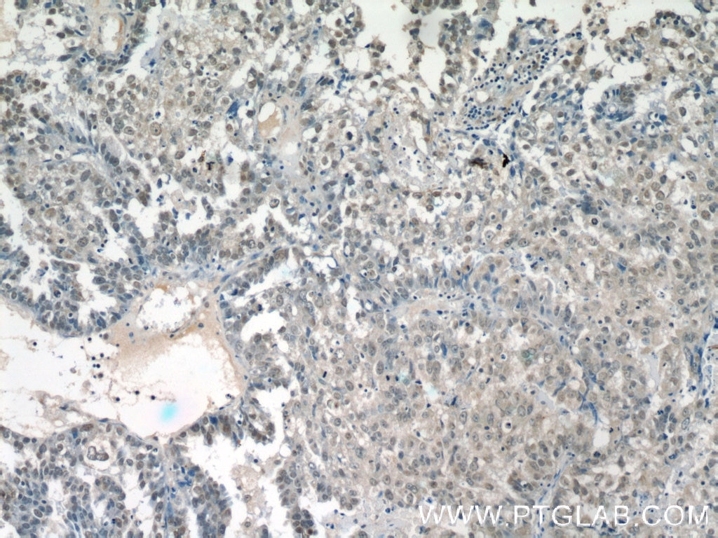 Immunohistochemistry (IHC) staining of human breast cancer tissue using SMARCE1 Monoclonal antibody (66182-1-Ig)