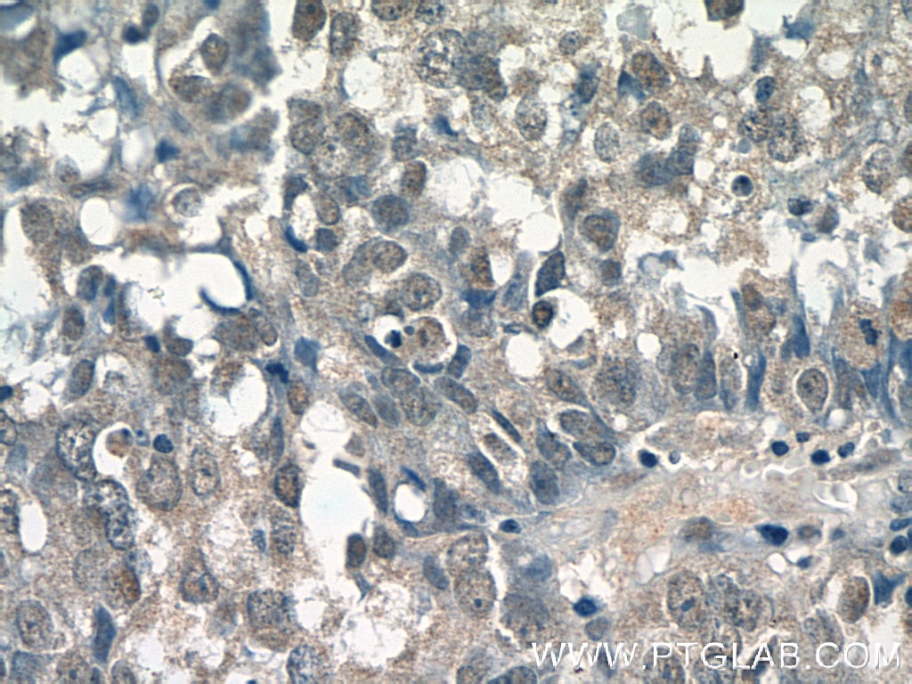 Immunohistochemistry (IHC) staining of human breast cancer tissue using SMARCE1 Monoclonal antibody (66182-1-Ig)