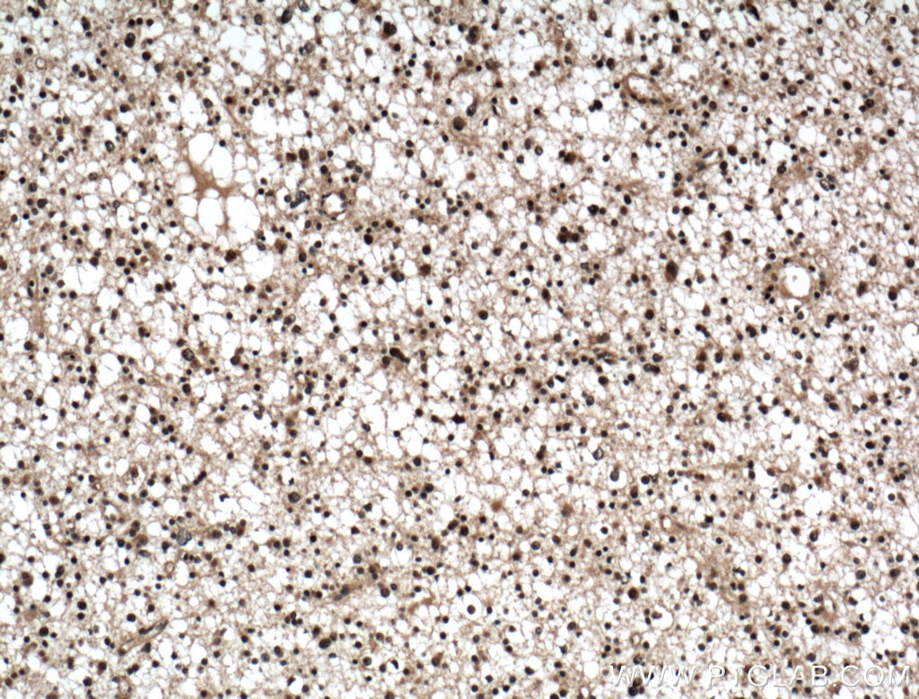 Immunohistochemistry (IHC) staining of human gliomas tissue using SMC1A Polyclonal antibody (21695-1-AP)