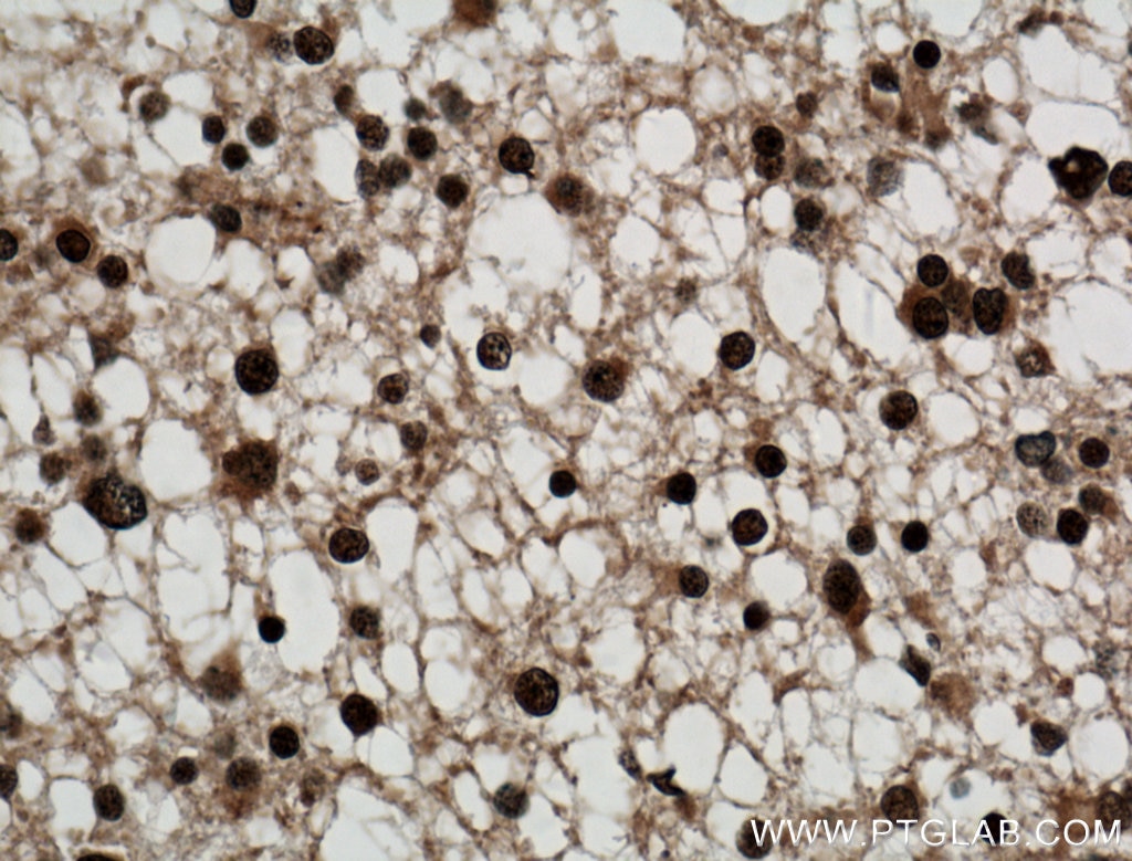 Immunohistochemistry (IHC) staining of human gliomas tissue using SMC1A Polyclonal antibody (21695-1-AP)