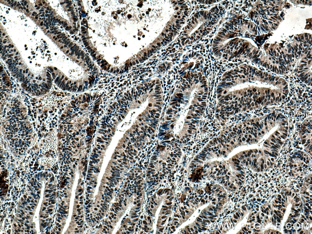 Immunohistochemistry (IHC) staining of human colon cancer tissue using SMC1A Monoclonal antibody (66987-1-Ig)