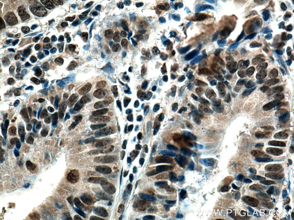 Immunohistochemistry (IHC) staining of human colon cancer tissue using SMC1A Monoclonal antibody (66987-1-Ig)