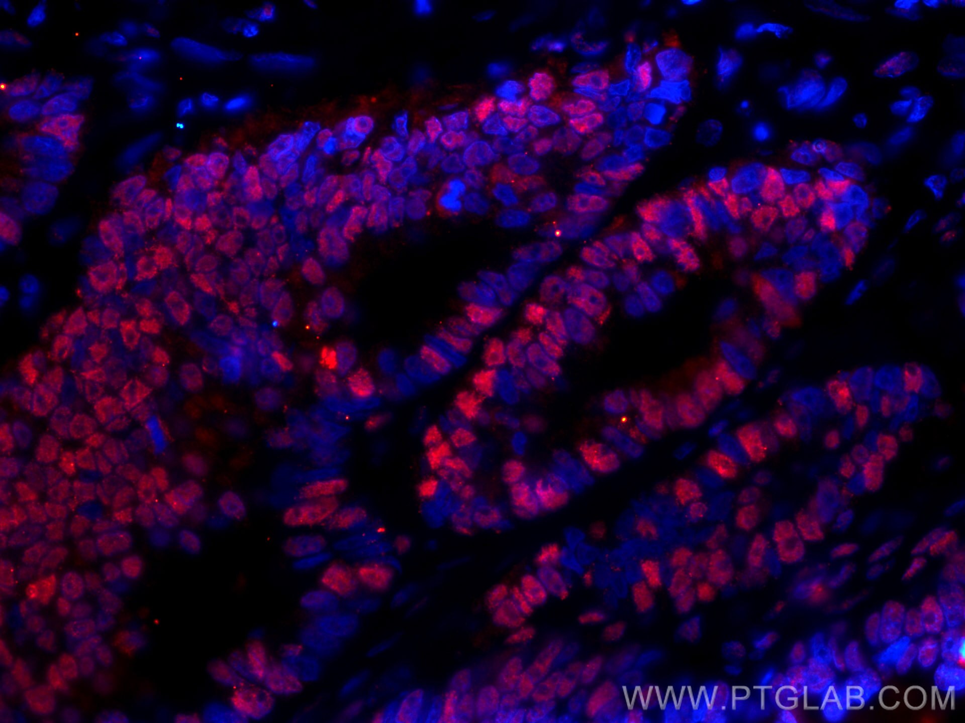 Immunofluorescence (IF) / fluorescent staining of human colon cancer tissue using CoraLite®594-conjugated SMC1A Monoclonal antibody (CL594-66987)