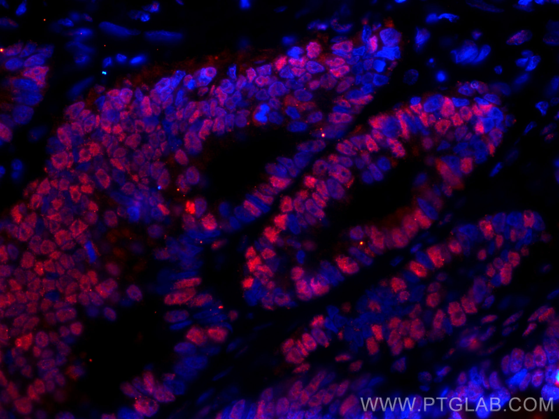 IF Staining of human colon cancer using CL594-66987