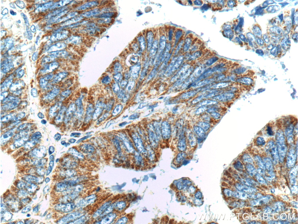 Immunohistochemistry (IHC) staining of human colon cancer tissue using SMCO4 Polyclonal antibody (25815-1-AP)