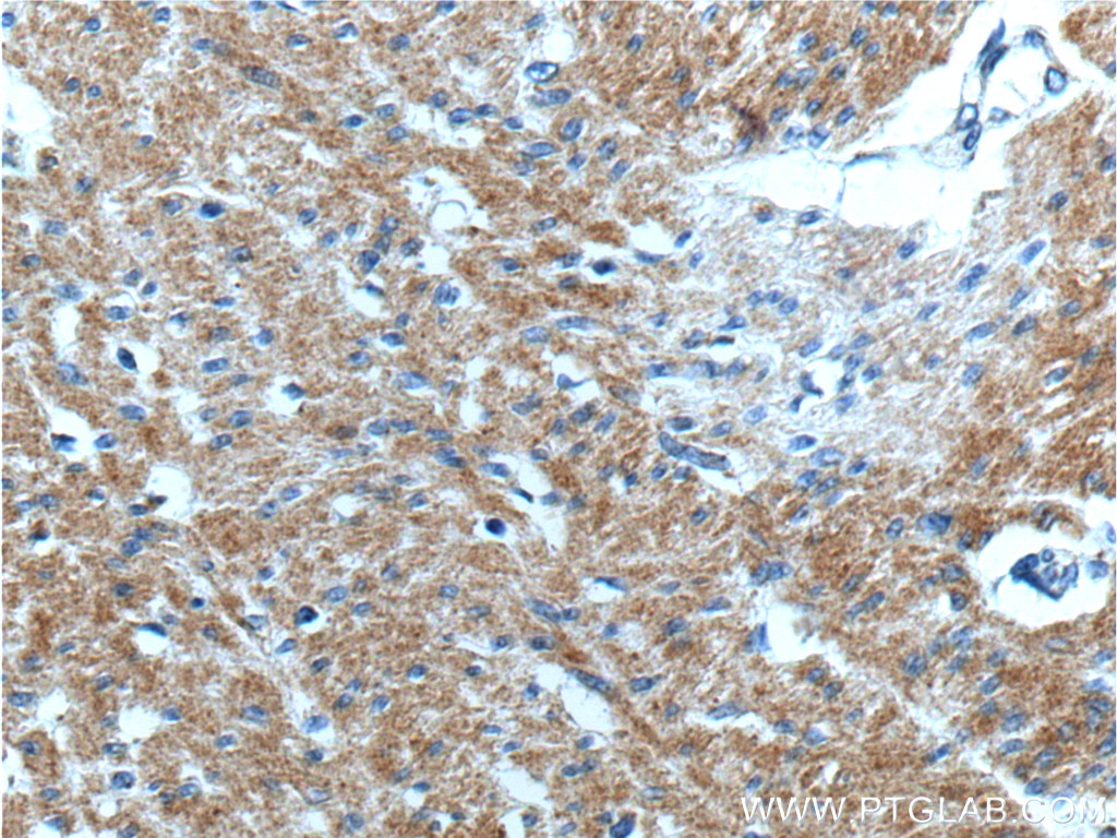 Immunohistochemistry (IHC) staining of human colon cancer tissue using SMCO4 Polyclonal antibody (25815-1-AP)