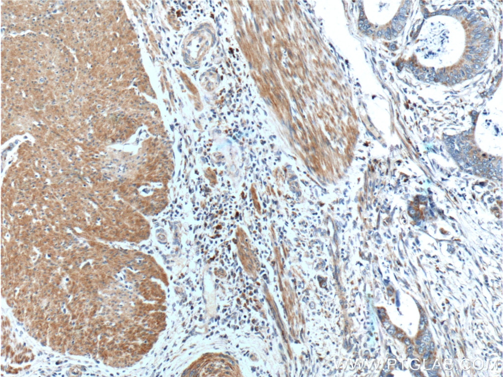 Immunohistochemistry (IHC) staining of human colon cancer tissue using SMCO4 Polyclonal antibody (25815-1-AP)