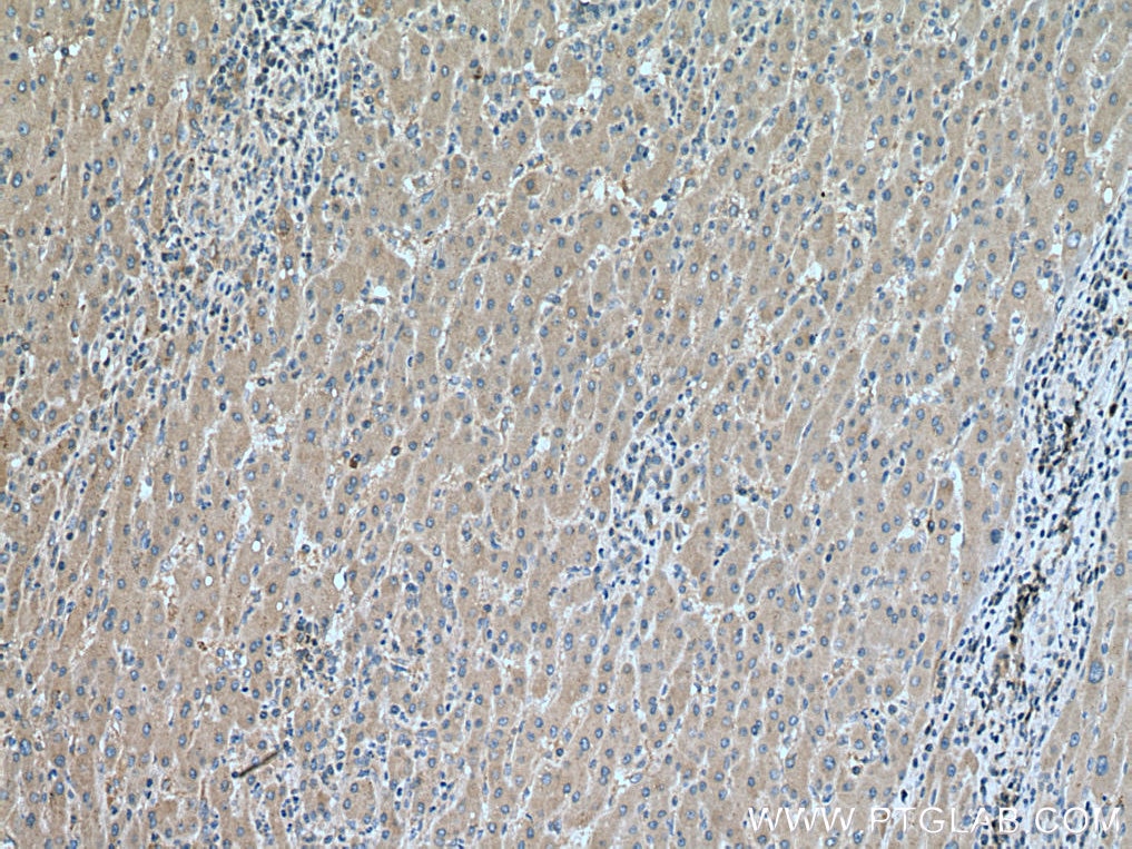 Immunohistochemistry (IHC) staining of human liver cancer tissue using SMCR7/MID49 Polyclonal antibody (28718-1-AP)