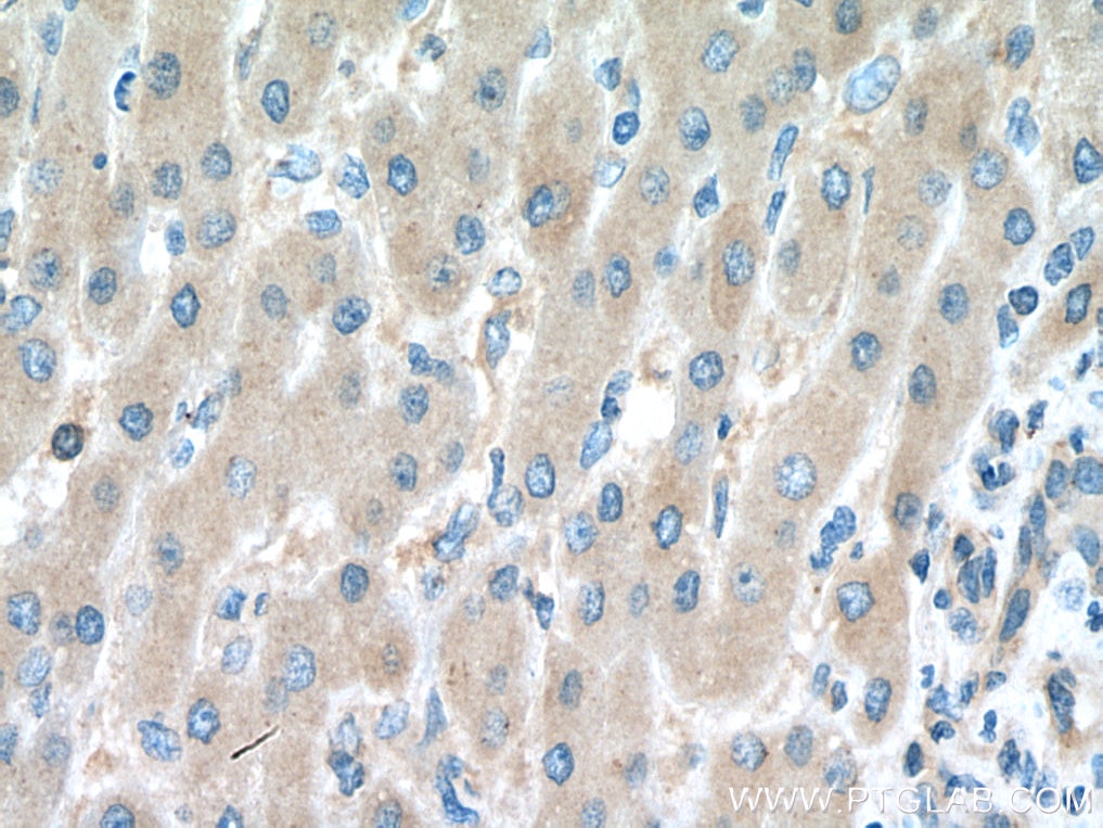 Immunohistochemistry (IHC) staining of human liver cancer tissue using SMCR7/MID49 Polyclonal antibody (28718-1-AP)
