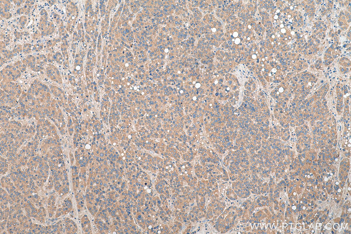 Immunohistochemistry (IHC) staining of human liver cancer tissue using SMCR7/MID49 Polyclonal antibody (28718-1-AP)