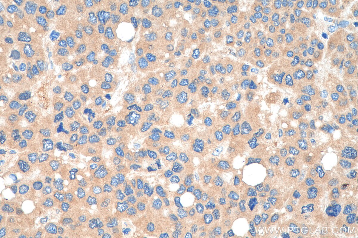 Immunohistochemistry (IHC) staining of human liver cancer tissue using SMCR7/MID49 Polyclonal antibody (28718-1-AP)