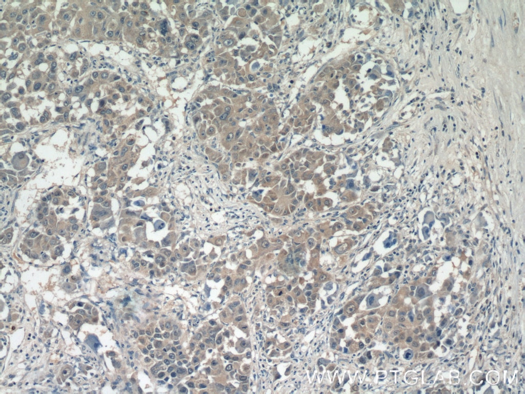 Immunohistochemistry (IHC) staining of human liver cancer tissue using SMCR7/MID49 Polyclonal antibody (16413-1-AP)