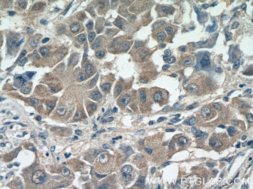 IHC staining of human liver cancer using 16413-1-AP