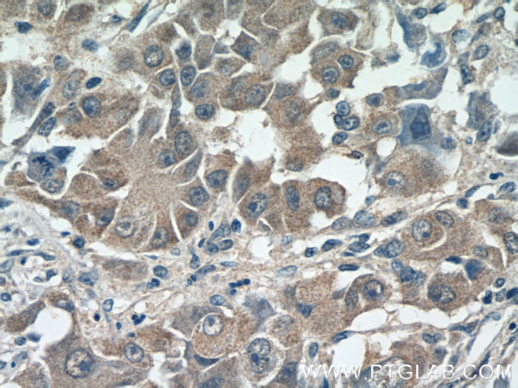 Immunohistochemistry (IHC) staining of human liver cancer tissue using SMCR7/MID49 Polyclonal antibody (16413-1-AP)