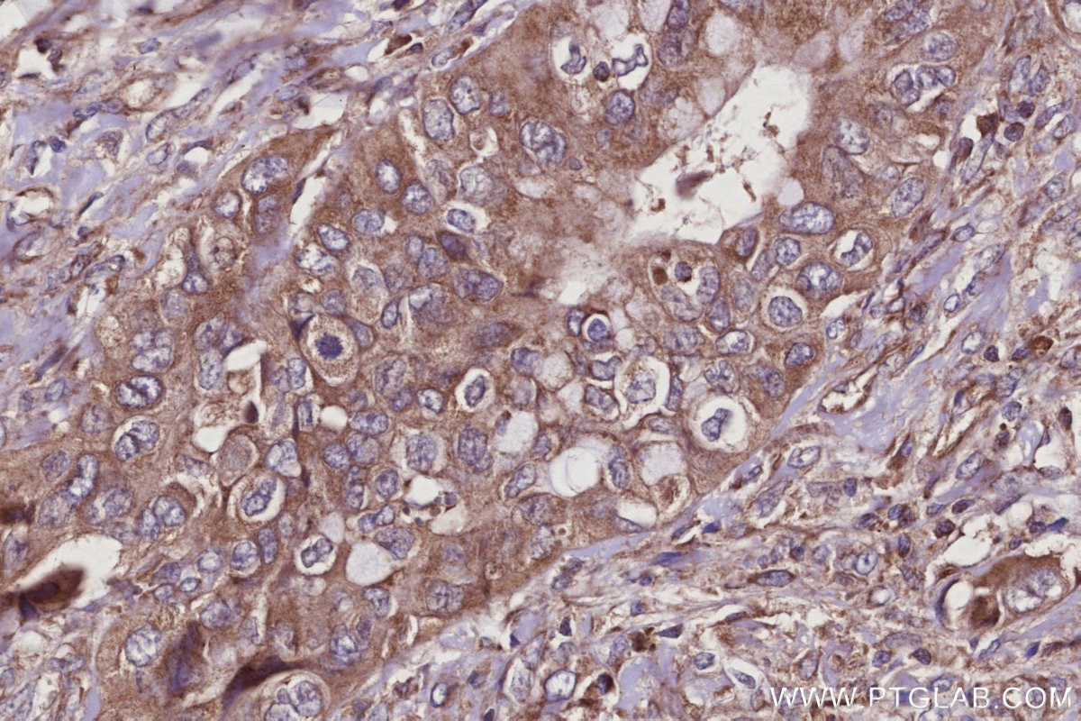 Immunohistochemistry (IHC) staining of human pancreas cancer tissue using SMCR7L/MID51 Monoclonal antibody (67808-1-Ig)