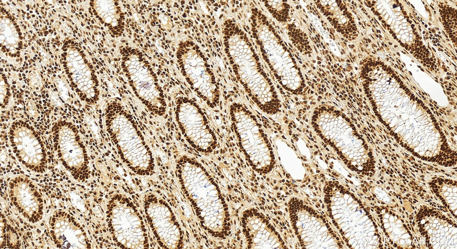 Immunohistochemistry (IHC) staining of human colon cancer tissue using SMEK1 Polyclonal antibody (26153-1-AP)