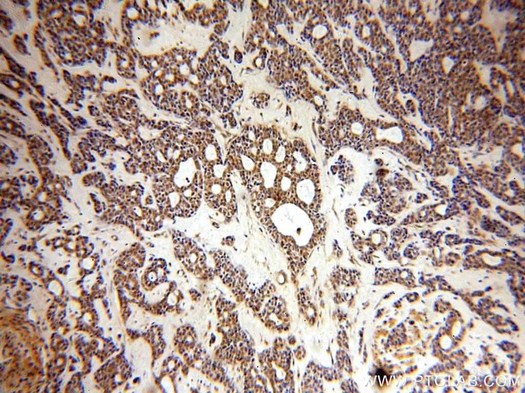 Immunohistochemistry (IHC) staining of human cervical cancer tissue using SMEK2 Polyclonal antibody (20348-1-AP)