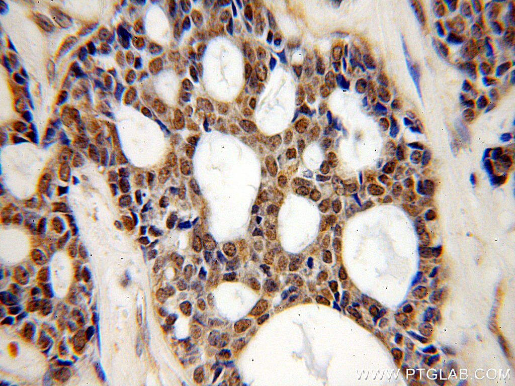 Immunohistochemistry (IHC) staining of human cervical cancer tissue using SMEK2 Polyclonal antibody (20348-1-AP)