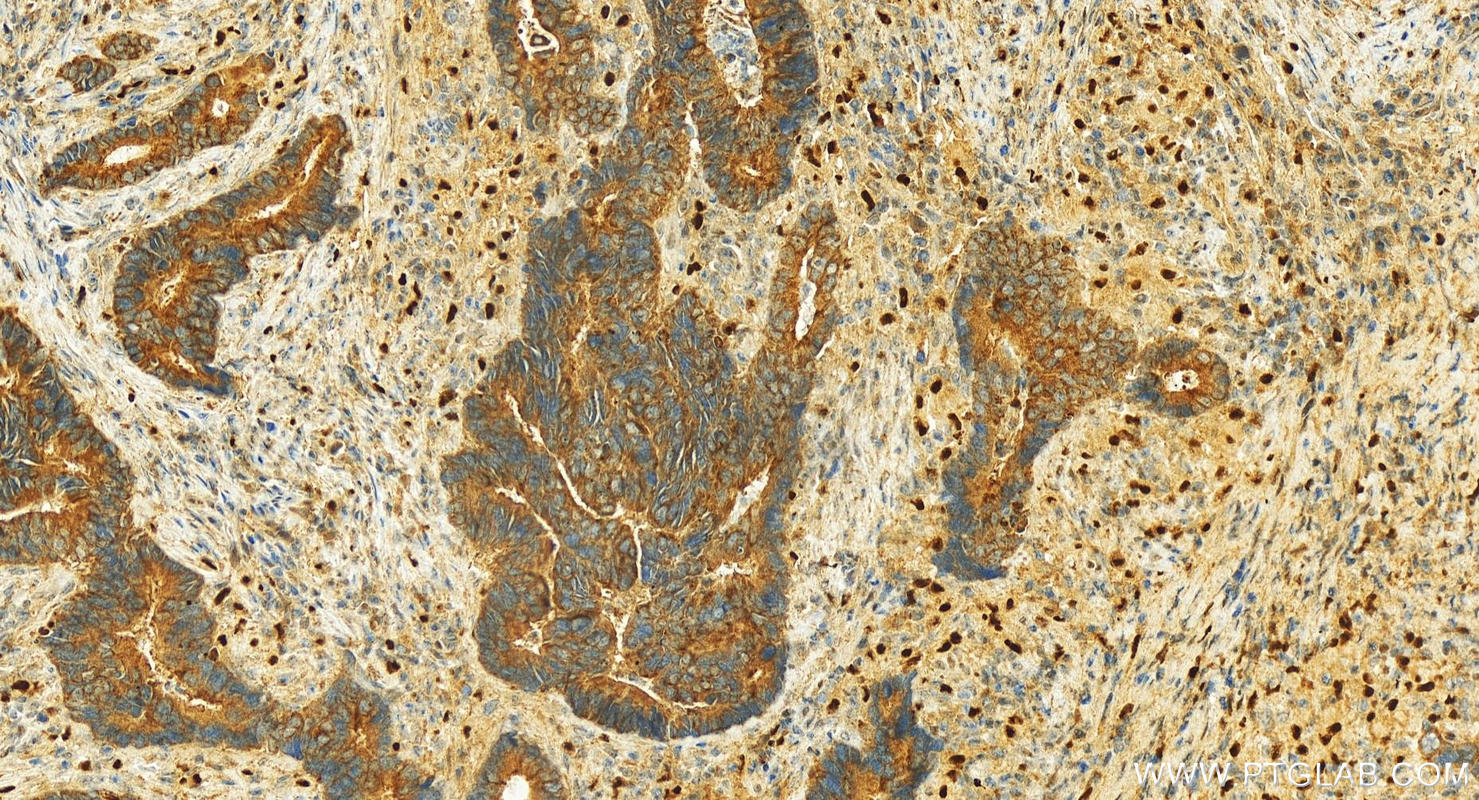Immunohistochemistry (IHC) staining of human colon cancer tissue using SMIM24 Polyclonal antibody (30036-1-AP)