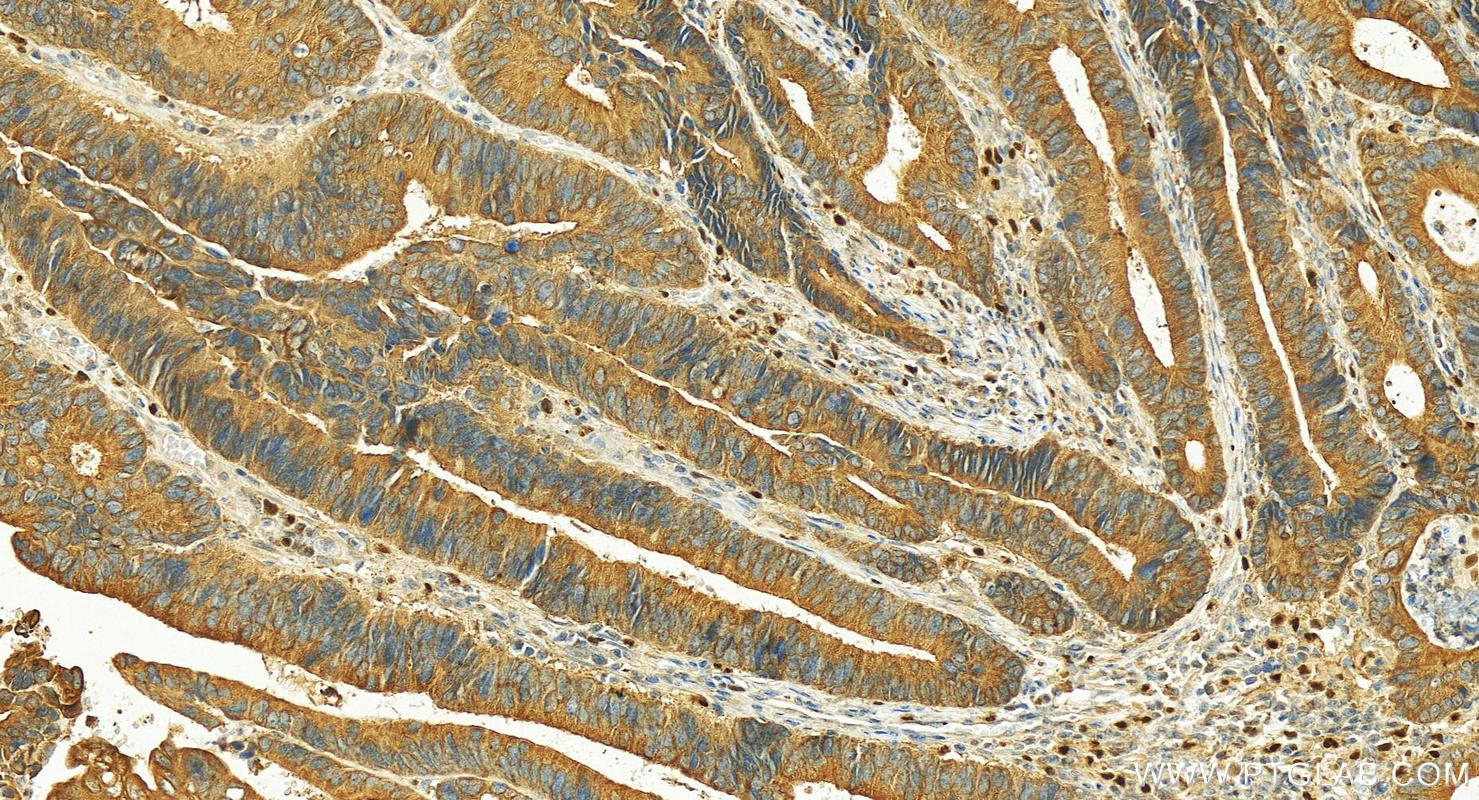 Immunohistochemistry (IHC) staining of human colon cancer tissue using SMIM24 Polyclonal antibody (30036-1-AP)
