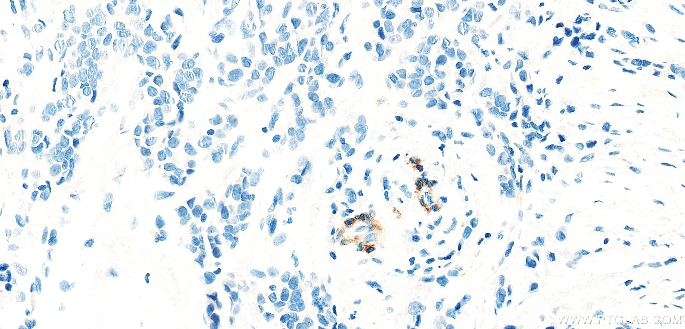 IHC staining of human breast cancer using 86654-3-RR Immunohistochemistry (IHC) staining of human breast cancer tissue using SMMHC Recombinant monoclonal antibody (86654-3-RR)