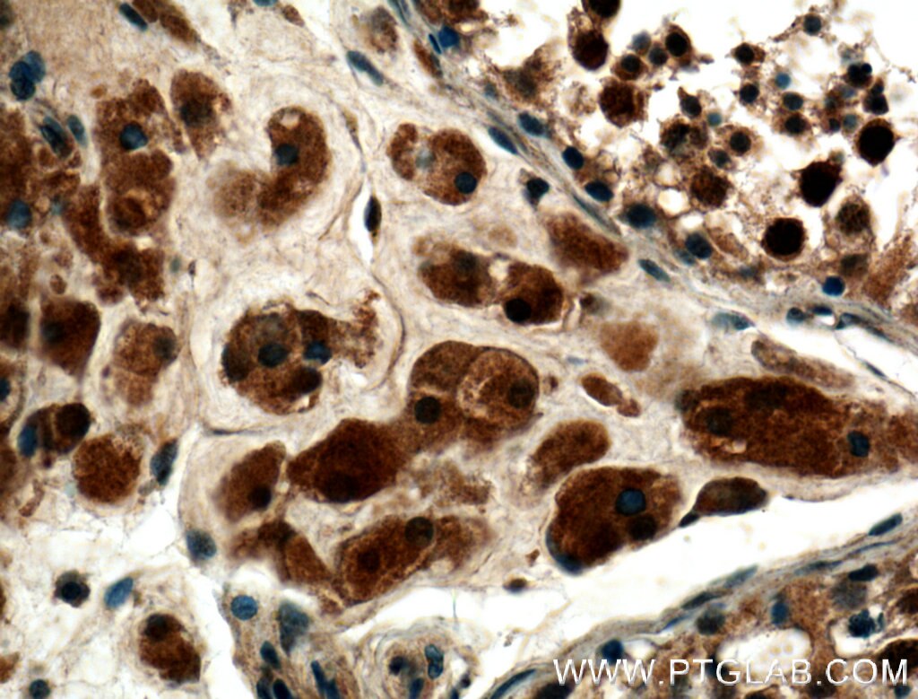 Immunohistochemistry (IHC) staining of human testis tissue using SMN Polyclonal antibody (22329-1-AP)