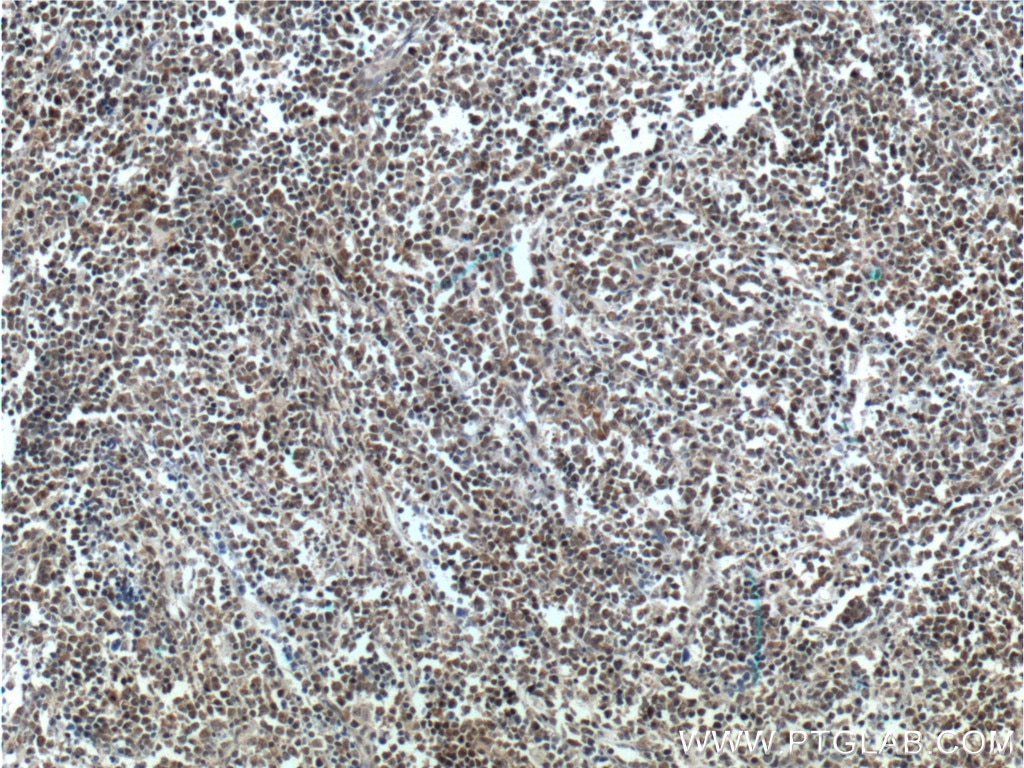 Immunohistochemistry (IHC) staining of human lymphoma tissue using SMNDC1 Polyclonal antibody (12178-1-AP)
