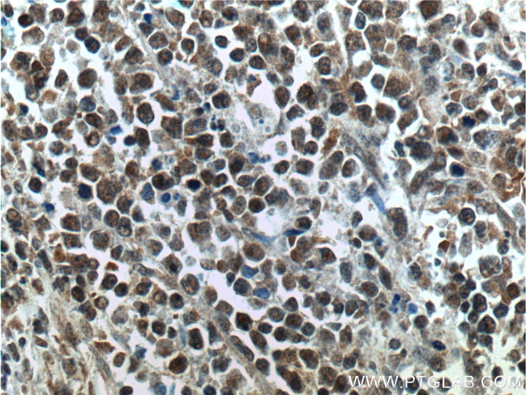 IHC staining of human lymphoma using 12178-1-AP
