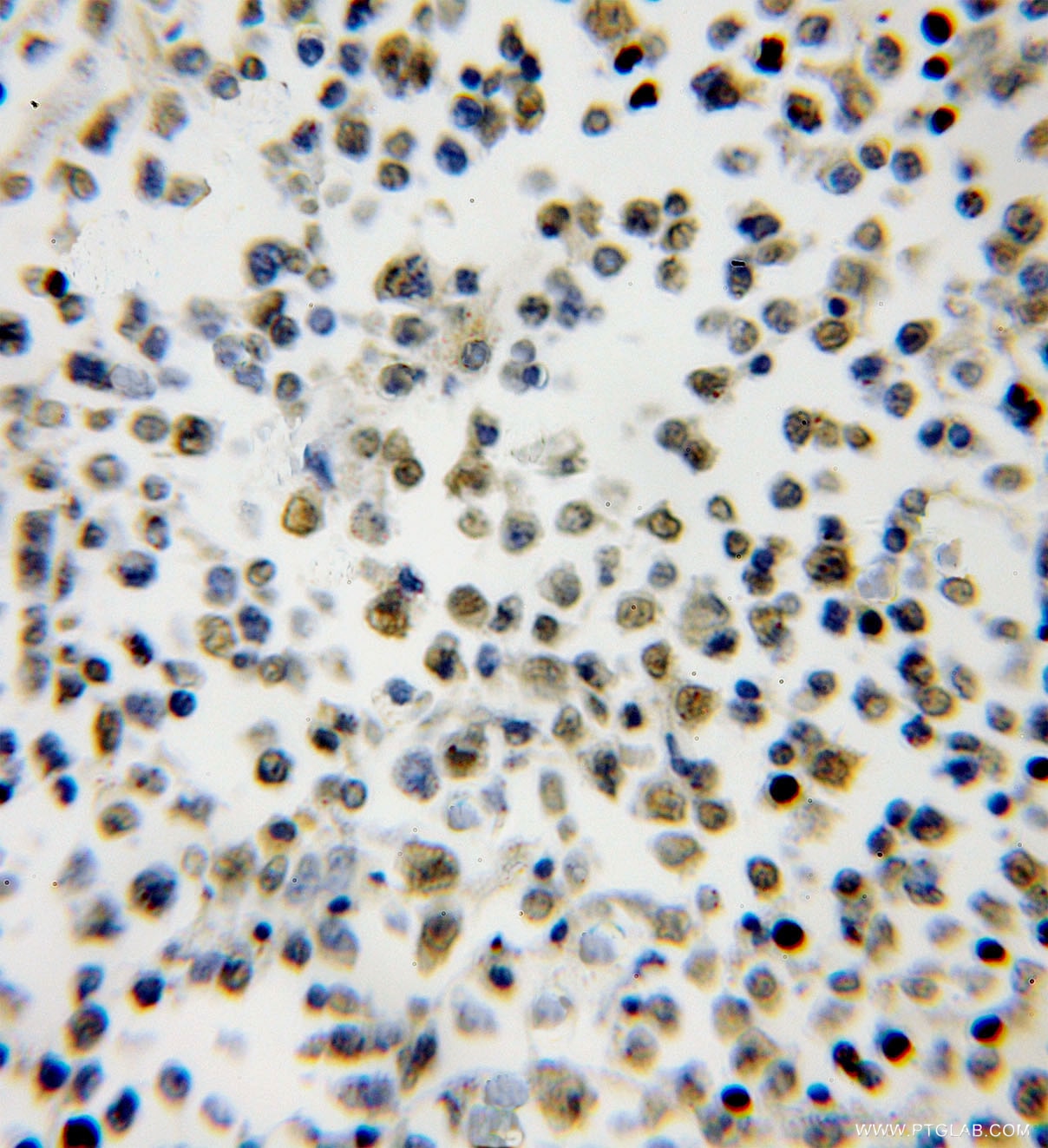 Immunohistochemistry (IHC) staining of human lymphoma tissue using SMNDC1 Polyclonal antibody (12178-1-AP)