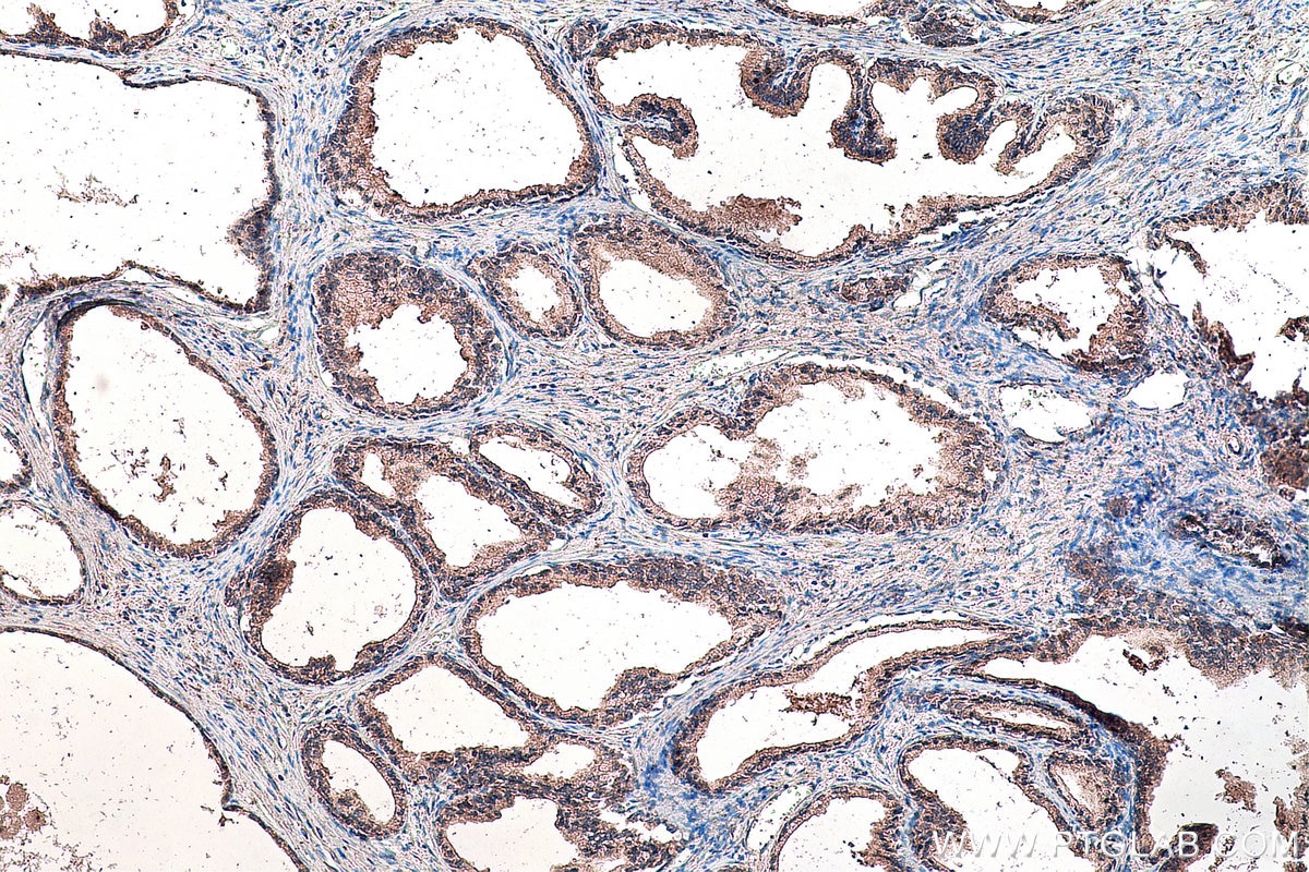 Immunohistochemistry (IHC) staining of human prostate cancer tissue using SMO Polyclonal antibody (20787-1-AP)